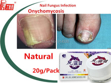 2 Packs Nail Fungus Treatment onychomycosis Paronychia toe Nail slits Infection Finger ointment chinese herbal products