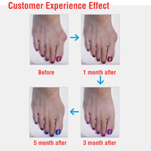 Sub toe toe braces Toe Separator Orthoses Beauty Health Braces foot care