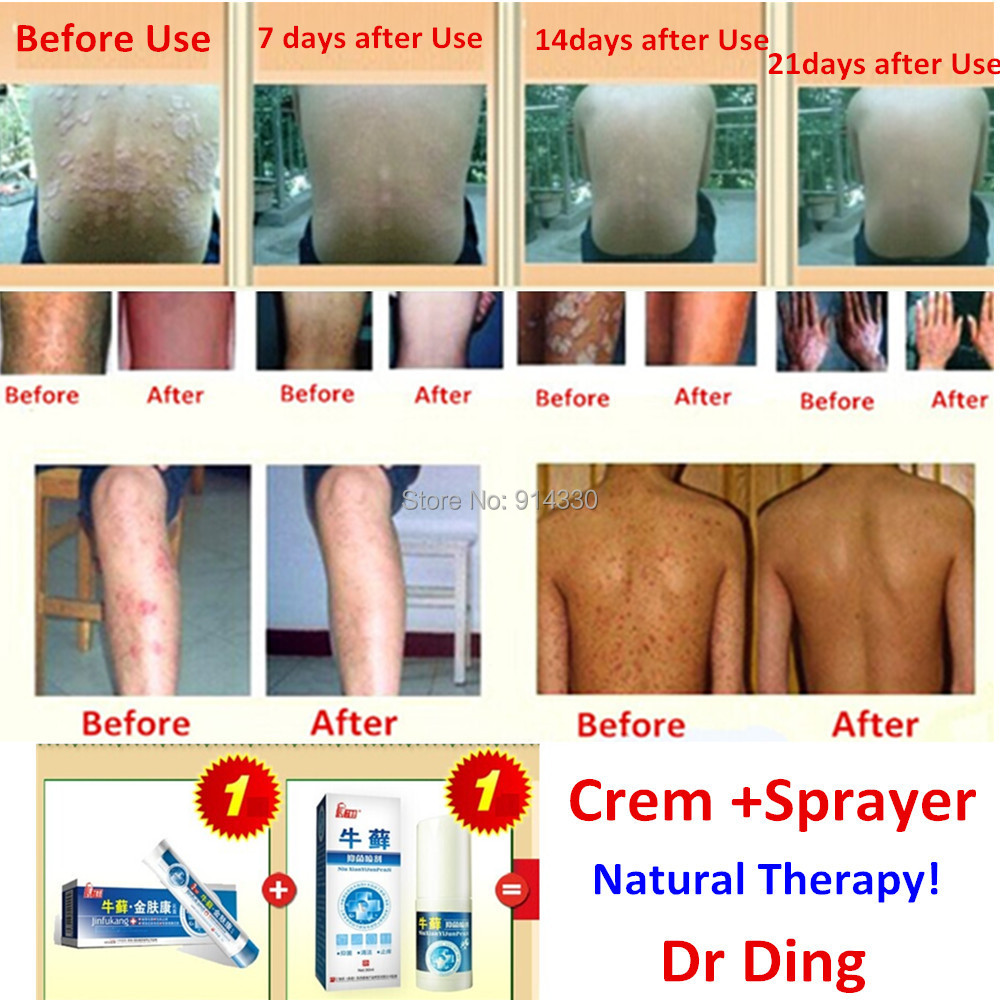 Crema da psoriasi in Tailandia