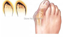 3PAIRNew Hotsale Beetle crusher Bone Ectropion Toes outer Appliance Professional Technology Health Care Products