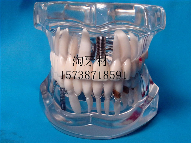 Dental Materials removable dental teeth model pathological tooth model Crystal Dental teeth Dental Materials