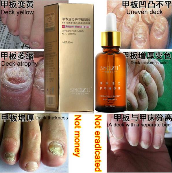 100 SnazII Fungal Nail Treatment Essence Nail and Foot Whitening Toe Nail Fungus Profession Removal Feet