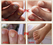 Hot sale 1pcs Fungal Nail Treatment Essence Nail and Foot Whitening Toe Nail Fungus Removal Feet