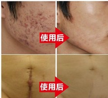 hot sale Nuobisong acne scar removal cream Acne Spots skin care treatment whitening face cream stretch marks moisturizing
