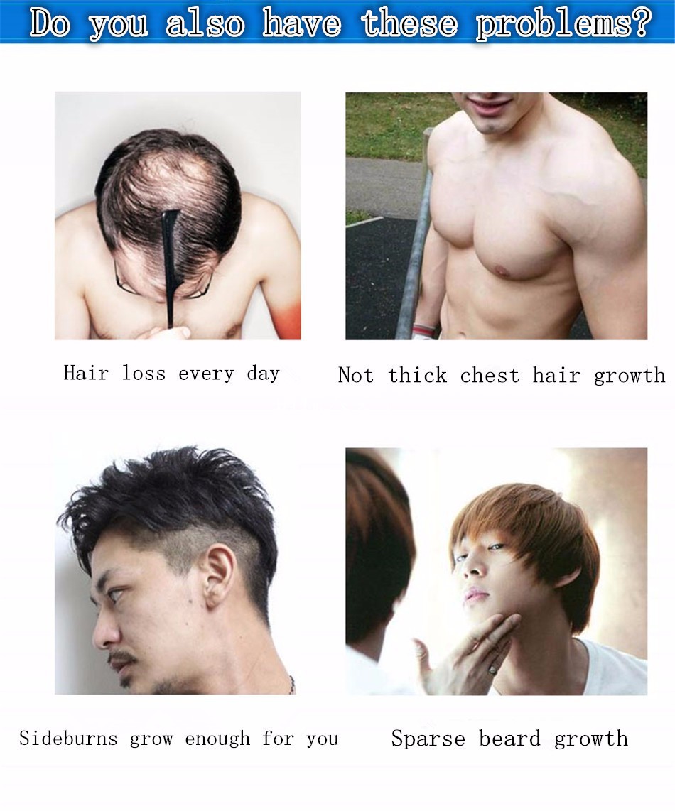 Facial Hair Loss In Men 77