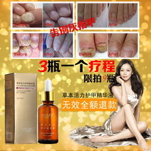 Fungal recover health to Nail onychomycosis Treatment Herbaceous energy Essence Foot Whitening Fungus Removal Care Gel