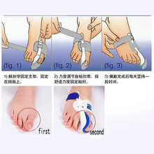 Hot Beetle crusher Bone Ectropion Toes outer Appliance Professional Technology Health Care Product left and right