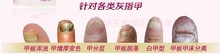 Nail Fungus for nails polish wholesale onychomycosis cutide oil brand tips gray new 2013 toe oils