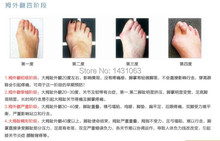 20pair 40pcs Sub toe toe braces Toe Separator Orthoses Beauty Health Braces