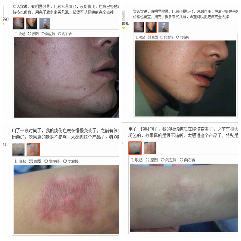 comment effacer une cicatrice au visage 6 mois comment effacer une cicatrice au visage 6 mois