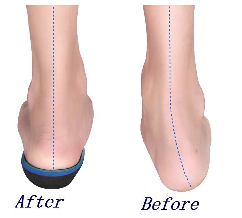High Arch supports insoles for flatfoot orthotics and cubitus varus