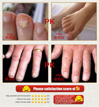 100 Original SnazII Fungal Nail Treatment Essence Nail and Foot Whitening Toe Nail Fungus ProfessionRemoval Feet