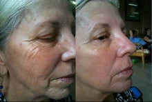 5pcs Boto x Acid Face Lift Powerful Anti wrinkle Anti aging Facial Skin Care Products Botulinum