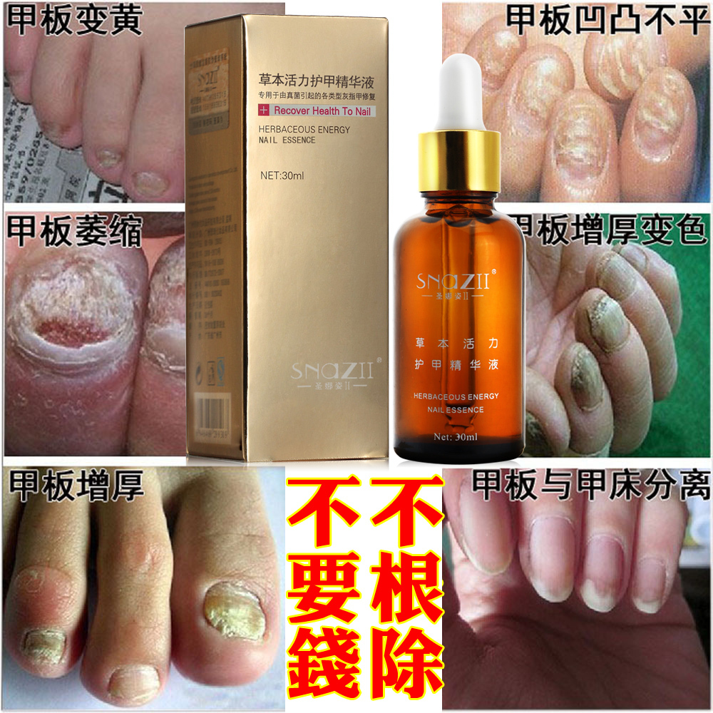 Nail Fungus for nails polish to remove armor onychomycosis sterilization Repair nails nursing of nails problem