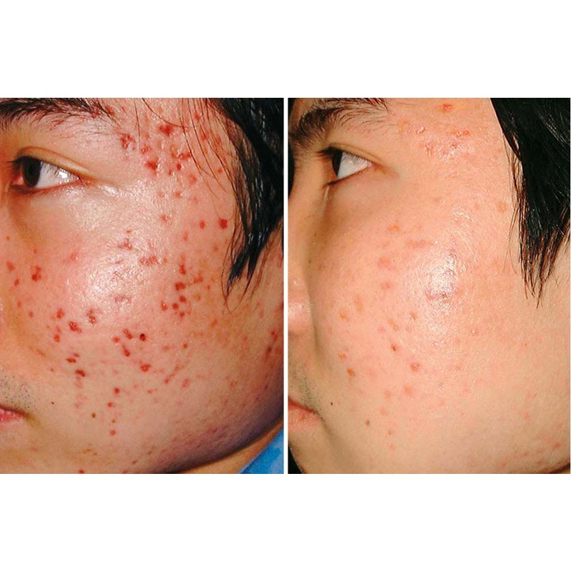 JAPAN Horse Oil face care acne scar removal cream Acne Spots skin care 